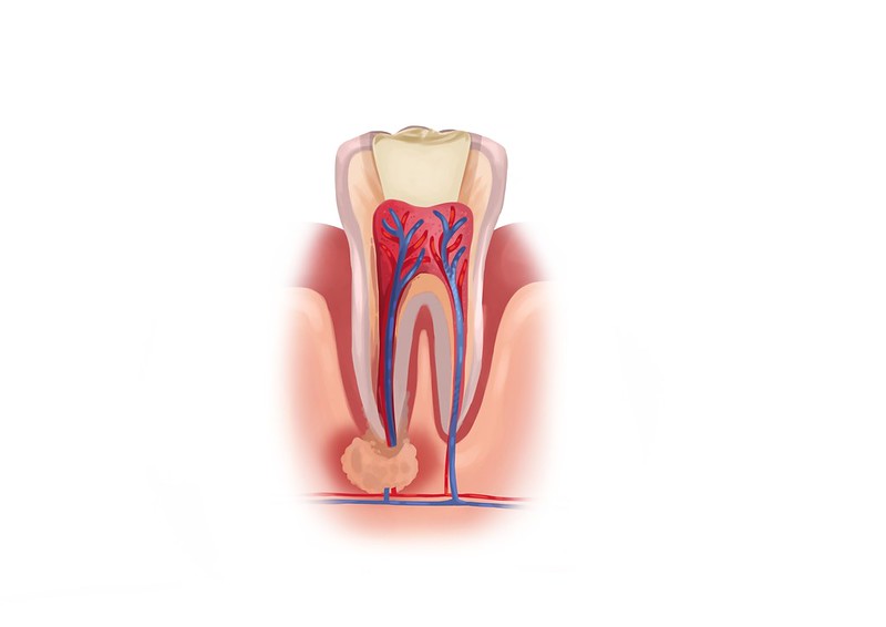 Tooth Root Canal